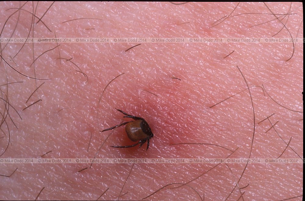 Ixodes ricinus sheep tick (?)  in human leg picked up in sweet chestnut forests of northern Italy