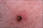 Ixodes ricinus sheep tick (?)  in human leg picked up in sweet chestnut forests of northern Italy